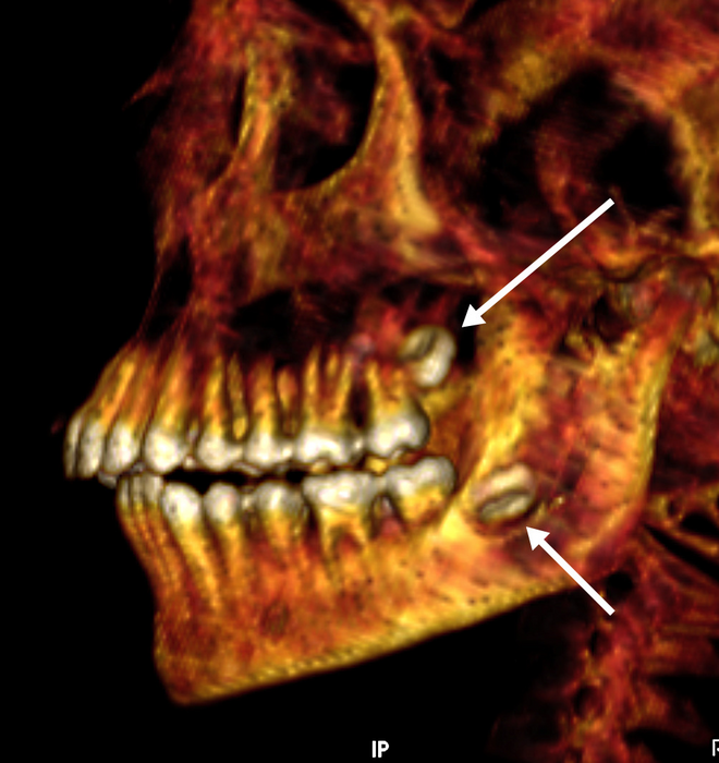 Tomograficzny skan uzębienia "Złotego chłopca". Zaznaczone niewyrżnięte zęby mądrości. Fot.: SN Saleem, SA Seddik, M el-Halwagy/ CC BY