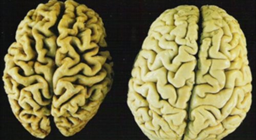 Mózg zdrowy (P) i mózg osoby chorującej na Alzheimera (L)