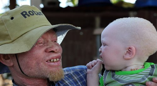 Albinizm to choroba genetyczna
